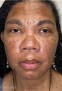 Dermal Fillers After Photo by Camille Cash, MD; Houston, TX - Case 47285