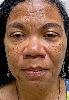 Dermal Fillers Before Photo by Camille Cash, MD; Houston, TX - Case 47285