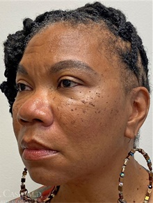 Dermal Fillers After Photo by Camille Cash, MD; Houston, TX - Case 47285