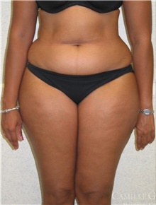 Liposuction Before Photo by Camille Cash, MD; Houston, TX - Case 47286