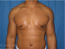 Male Breast Reduction After Photo by Camille Cash, MD; Houston, TX - Case 47287