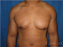 Male Breast Reduction Before Photo by Camille Cash, MD; Houston, TX - Case 47287