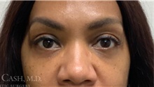 Eyelid Surgery After Photo by Camille Cash, MD; Houston, TX - Case 47289