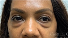 Eyelid Surgery Before Photo by Camille Cash, MD; Houston, TX - Case 47289
