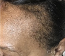 Hair Transplant Before Photo by Camille Cash, MD; Houston, TX - Case 47290