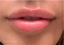 Lip Augmentation/Enhancement After Photo by Camille Cash, MD; Houston, TX - Case 47291
