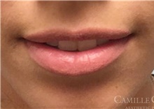 Lip Augmentation/Enhancement Before Photo by Camille Cash, MD; Houston, TX - Case 47291