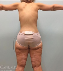 Thigh Lift After Photo by Camille Cash, MD; Houston, TX - Case 47292
