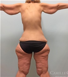 Thigh Lift Before Photo by Camille Cash, MD; Houston, TX - Case 47292