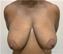 Breast Lift Before Photo by Camille Cash, MD; Houston, TX - Case 47301