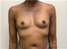 Breast Augmentation Before Photo by Camille Cash, MD; Houston, TX - Case 47302