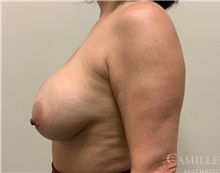 Breast Implant Removal Before Photo by Camille Cash, MD; Houston, TX - Case 47305