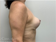 Breast Implant Removal After Photo by Camille Cash, MD; Houston, TX - Case 47305