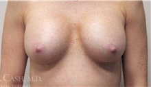 Breast Implant Revision After Photo by Camille Cash, MD; Houston, TX - Case 47306