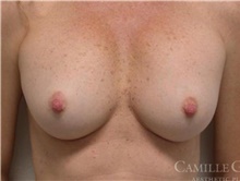 Breast Implant Revision Before Photo by Camille Cash, MD; Houston, TX - Case 47307