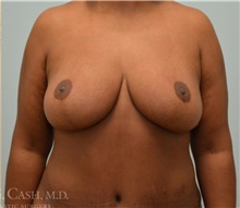 Breast Lift After Photo by Camille Cash, MD; Houston, TX - Case 47310
