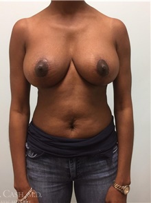 Breast Reduction After Photo by Camille Cash, MD; Houston, TX - Case 47311