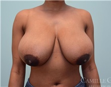 Breast Reduction Before Photo by Camille Cash, MD; Houston, TX - Case 47312