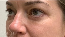 Eyelid Surgery After Photo by Camille Cash, MD; Houston, TX - Case 47314