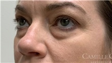 Eyelid Surgery Before Photo by Camille Cash, MD; Houston, TX - Case 47314