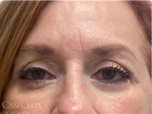 Eyelid Surgery After Photo by Camille Cash, MD; Houston, TX - Case 47315