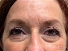 Eyelid Surgery Before Photo by Camille Cash, MD; Houston, TX - Case 47315