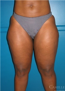 Liposuction Before Photo by Camille Cash, MD; Houston, TX - Case 47316
