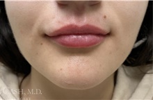 Lip Augmentation/Enhancement After Photo by Camille Cash, MD; Houston, TX - Case 47319