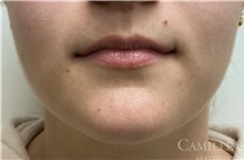 Lip Augmentation/Enhancement Before Photo by Camille Cash, MD; Houston, TX - Case 47319