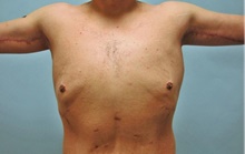 Male Breast Reduction After Photo by Camille Cash, MD; Houston, TX - Case 47320