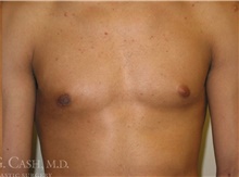 Male Breast Reduction After Photo by Camille Cash, MD; Houston, TX - Case 47321