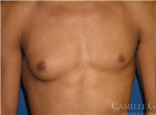 Male Breast Reduction Before Photo by Camille Cash, MD; Houston, TX - Case 47321