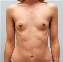 Breast Augmentation Before Photo by Camille Cash, MD; Houston, TX - Case 47328