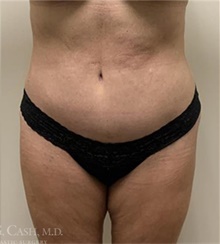 Tummy Tuck After Photo by Camille Cash, MD; Houston, TX - Case 47329