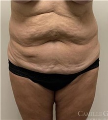 Tummy Tuck Before Photo by Camille Cash, MD; Houston, TX - Case 47329