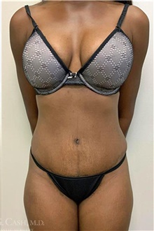 Tummy Tuck After Photo by Camille Cash, MD; Houston, TX - Case 47330
