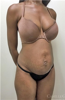 Tummy Tuck Before Photo by Camille Cash, MD; Houston, TX - Case 47330