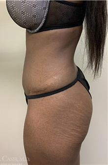Tummy Tuck After Photo by Camille Cash, MD; Houston, TX - Case 47330