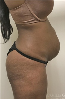 Tummy Tuck Before Photo by Camille Cash, MD; Houston, TX - Case 47330