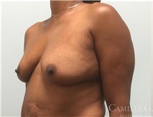 Breast Augmentation Before Photo by Camille Cash, MD; Houston, TX - Case 47354
