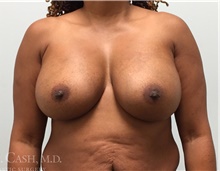 Breast Augmentation After Photo by Camille Cash, MD; Houston, TX - Case 47354