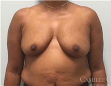 Breast Augmentation Before Photo by Camille Cash, MD; Houston, TX - Case 47354