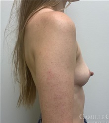 Breast Augmentation Before Photo by Camille Cash, MD; Houston, TX - Case 47357