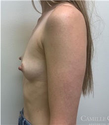 Breast Augmentation Before Photo by Camille Cash, MD; Houston, TX - Case 47357