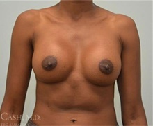 Breast Augmentation After Photo by Camille Cash, MD; Houston, TX - Case 47359
