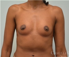 Breast Augmentation Before Photo by Camille Cash, MD; Houston, TX - Case 47359
