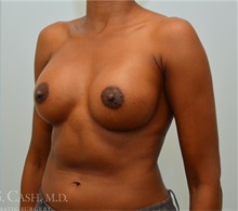 Breast Augmentation After Photo by Camille Cash, MD; Houston, TX - Case 47359