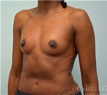 Breast Augmentation Before Photo by Camille Cash, MD; Houston, TX - Case 47359
