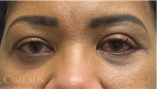 Eyelid Surgery After Photo by Camille Cash, MD; Houston, TX - Case 47365