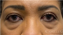 Eyelid Surgery Before Photo by Camille Cash, MD; Houston, TX - Case 47365